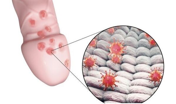Αλλεργία στο τζελ μεγέθυνσης πέους