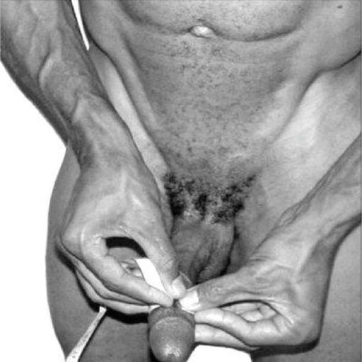 Μέτρηση πέους πριν από τη μεγέθυνση